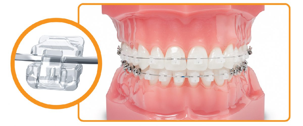 Global Dental Orthodontic Wax Industry