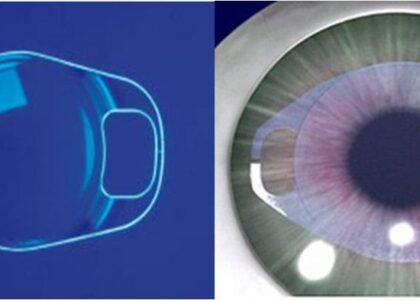 Global Implantable Collamer Lens Industry