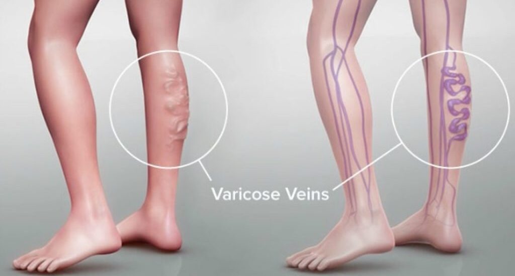 Global Varicose Vein Treatment Industry