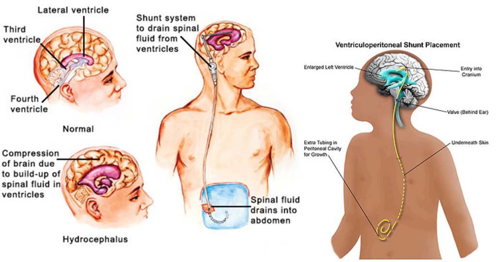 Hydrocephalus Shunt Market