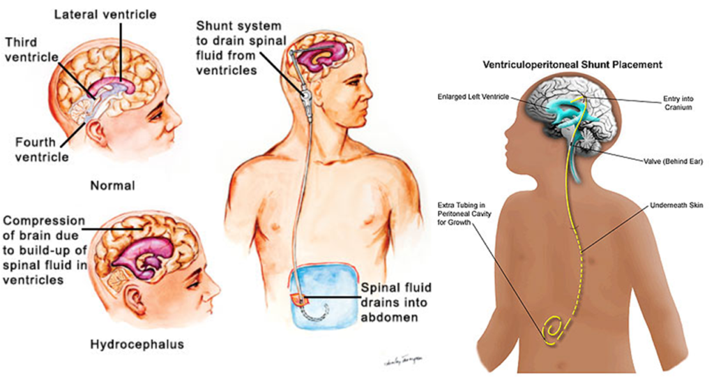 Hydrocephalus Shunt Market