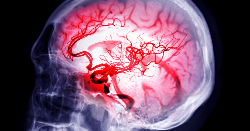 Intracranial Aneurysm Market