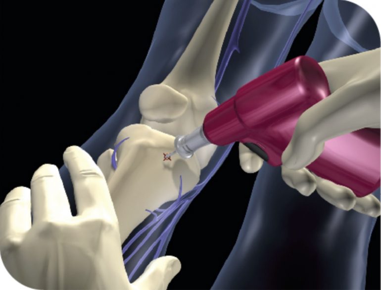 Intraosseous Devices Market