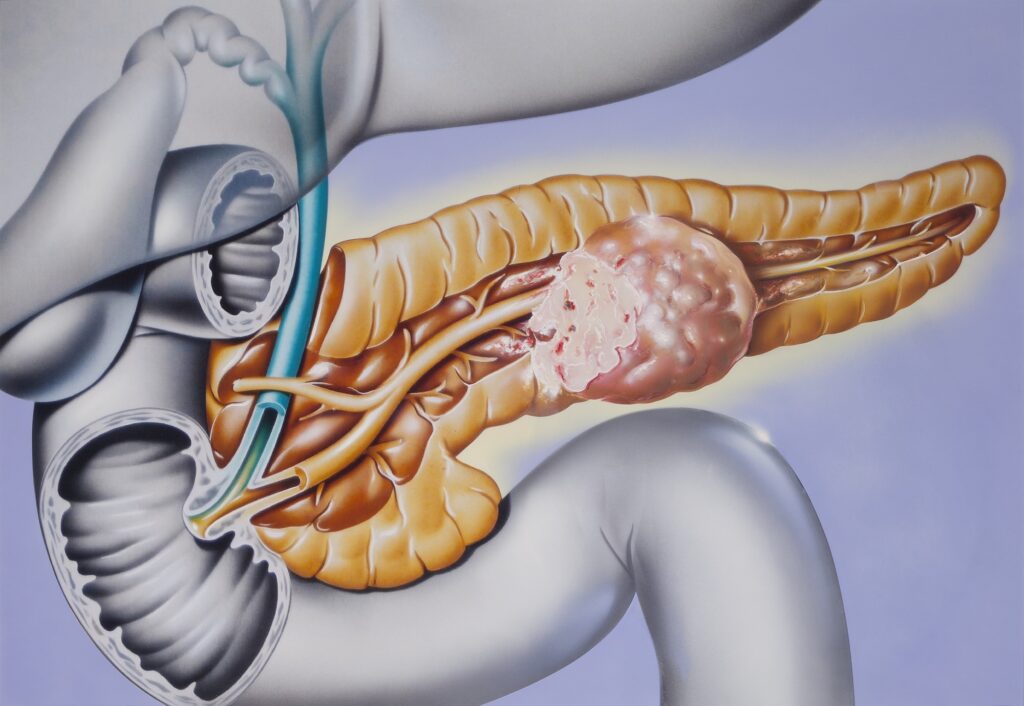 Neuroendocrine Carcinoma Treatment Market