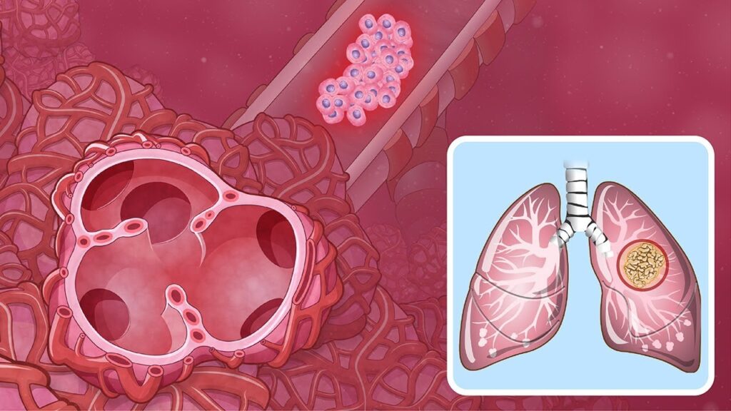 Non-Small Cell Lung Cancer Market