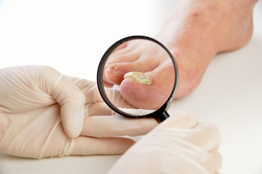 Onychomycosis Treatment Market