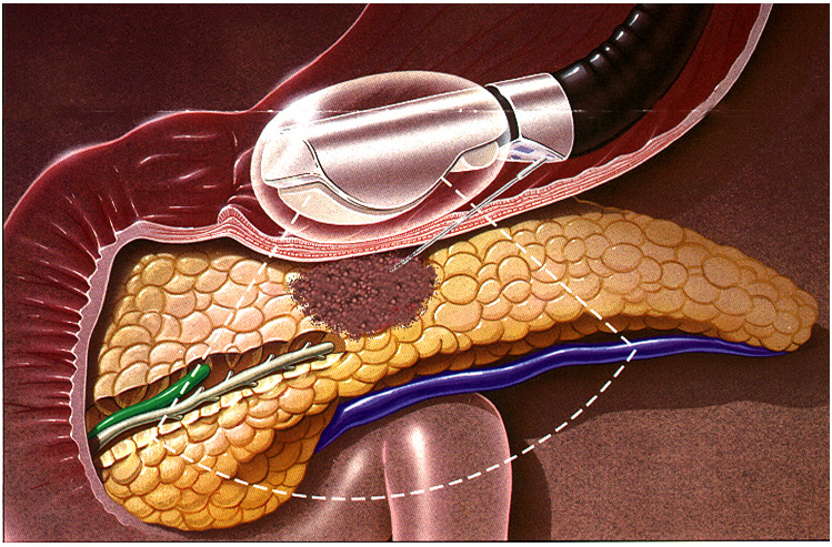 Pancreatic Elastase Testing Market