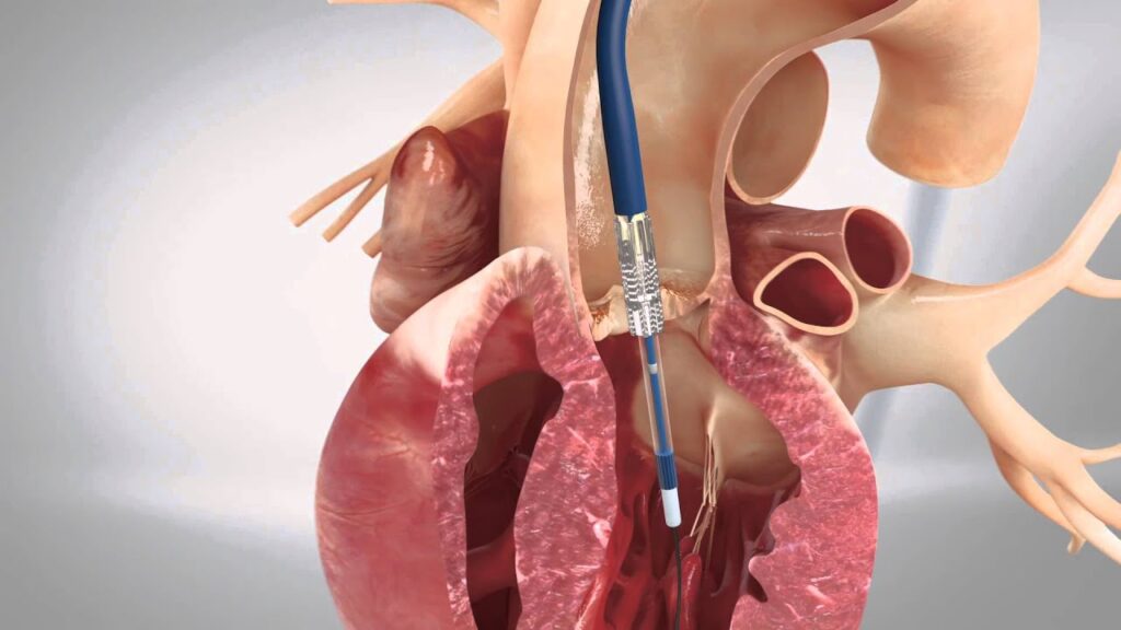 Pediatric Heart Valve Repair and Replacement Market