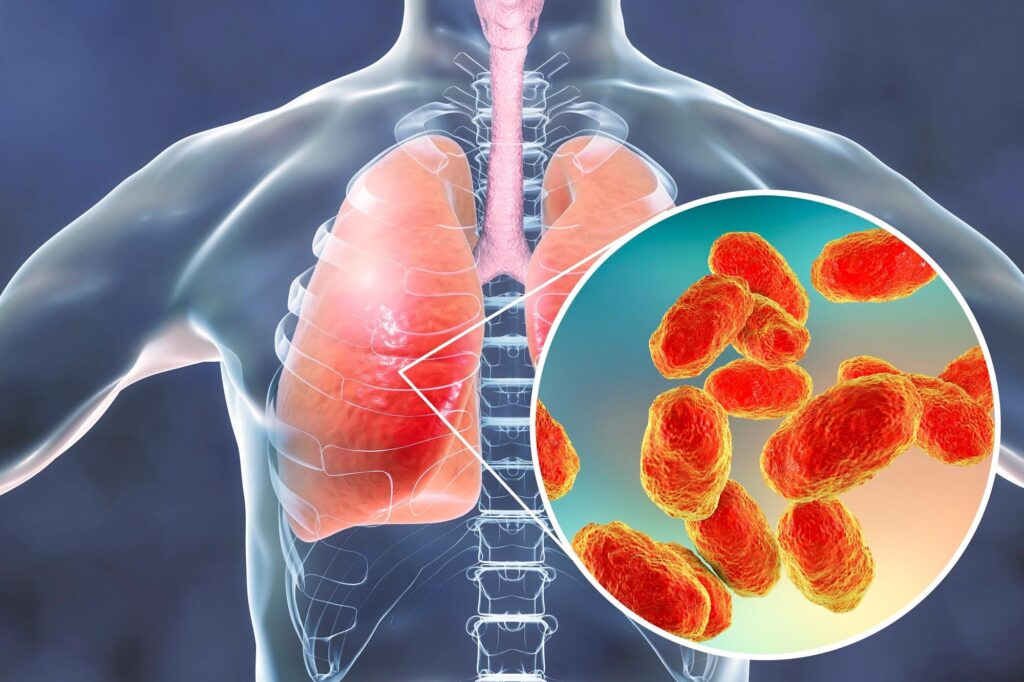 Pneumonia Diagnostics Market