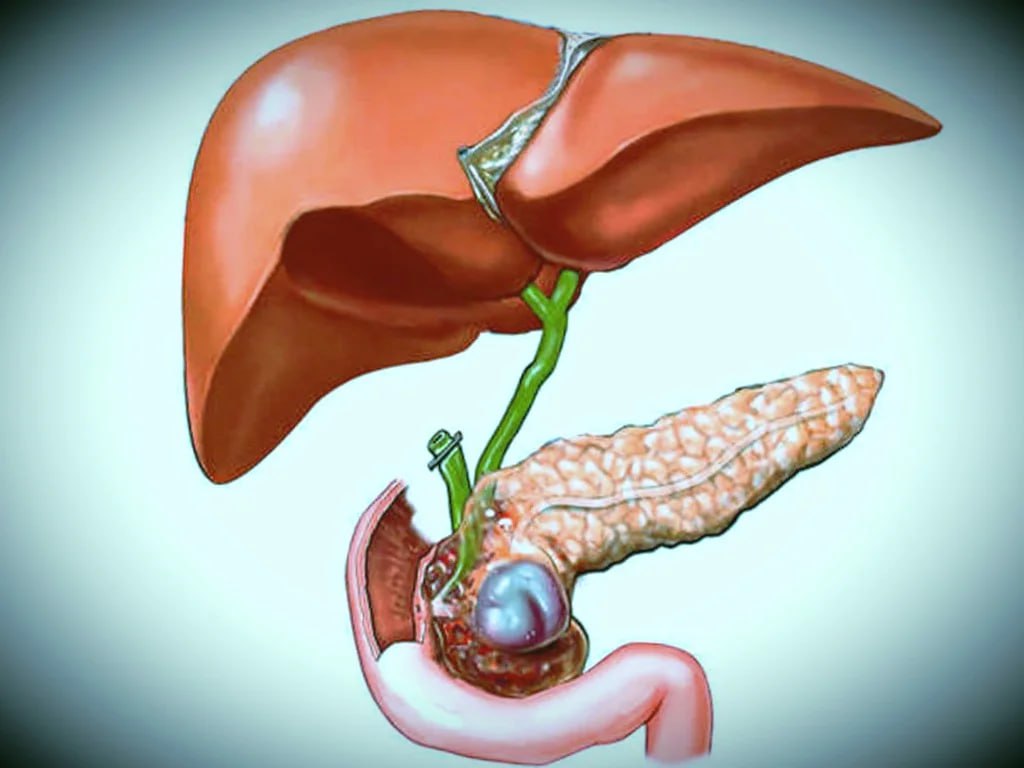 Primary Sclerosing Cholangitis Market