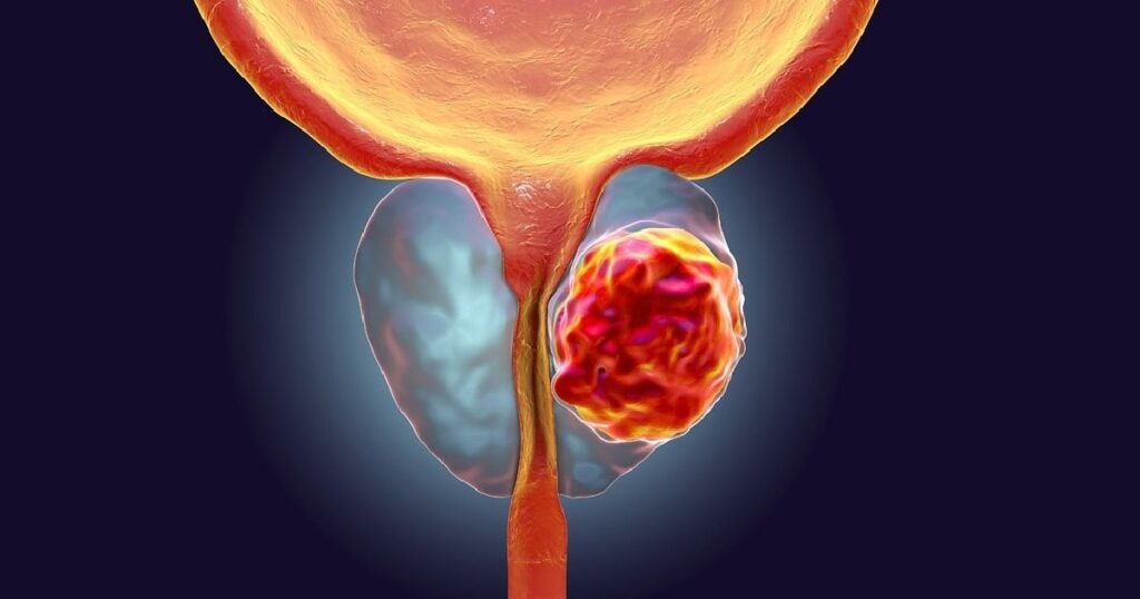 Prostate Cancer Market