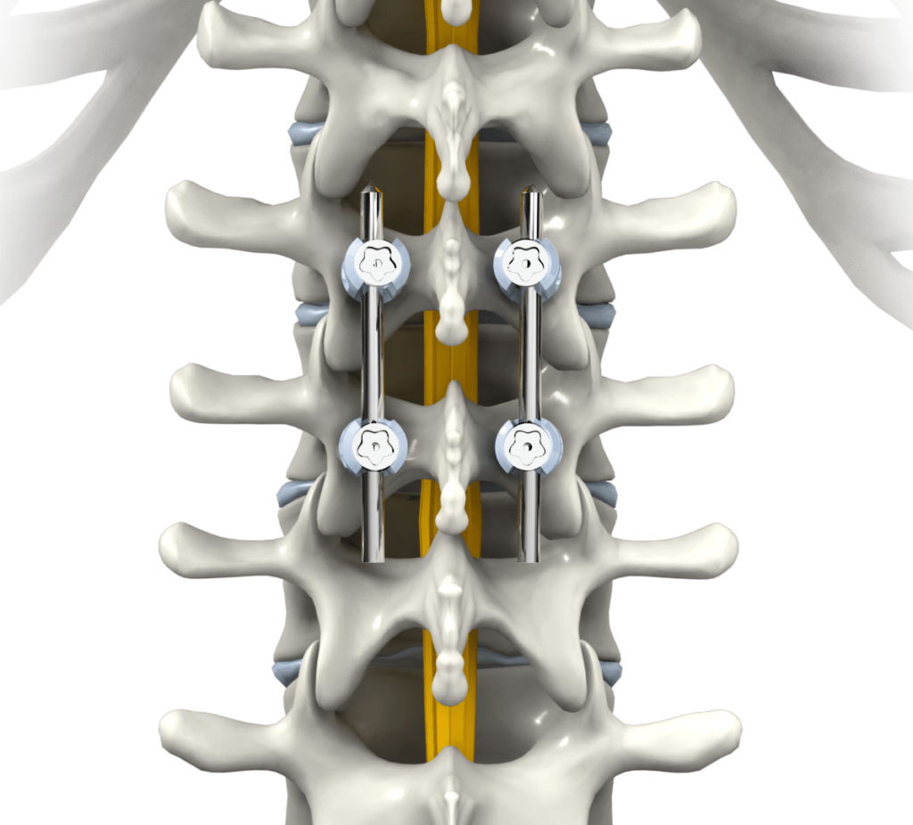 Spinal Fusion Market