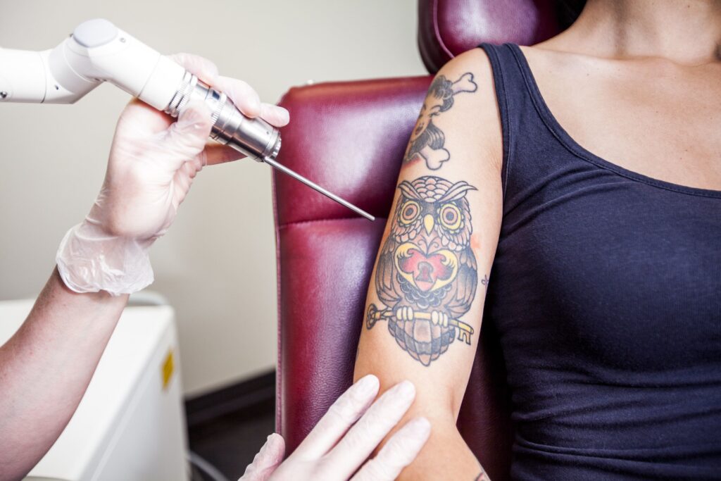 Tattoo Removal Laser Market