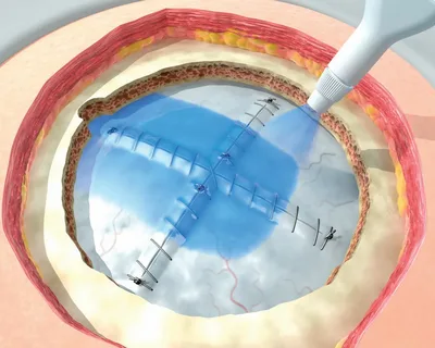 Tissue Sealants and Tissue Adhesive Market