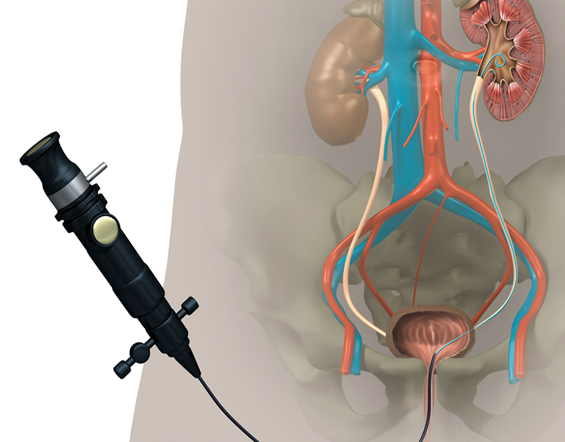 Ureteral Stent Market