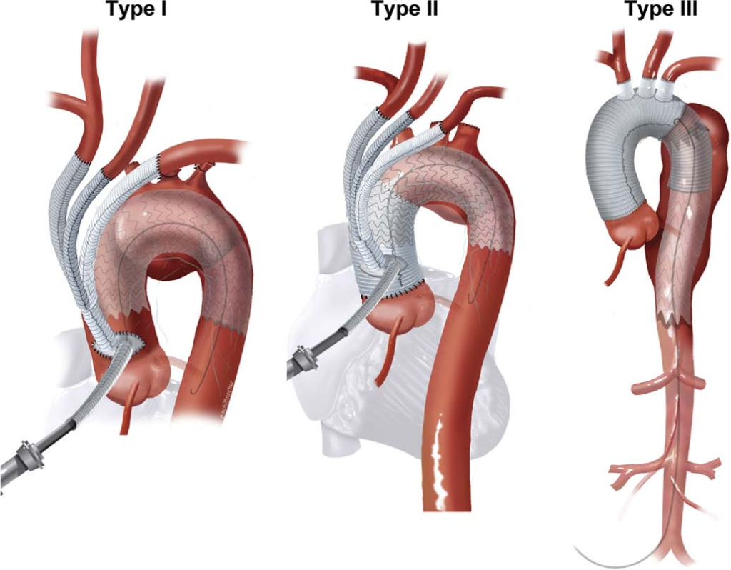 Aortic Stents Grafts Market