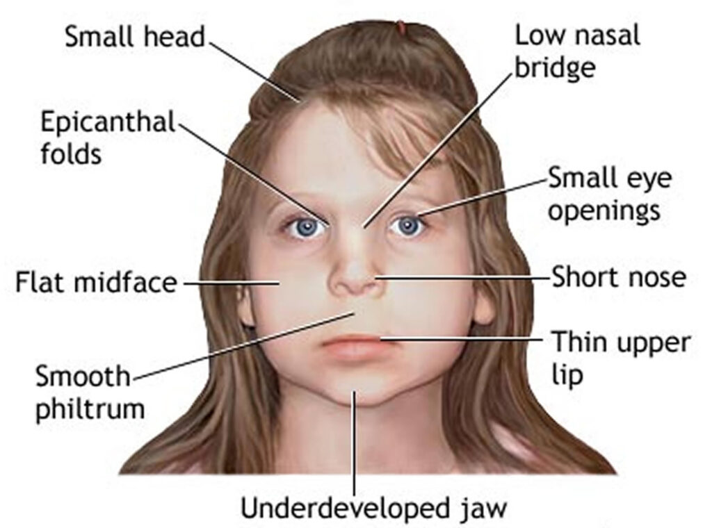 Barlow’s Syndrome Market