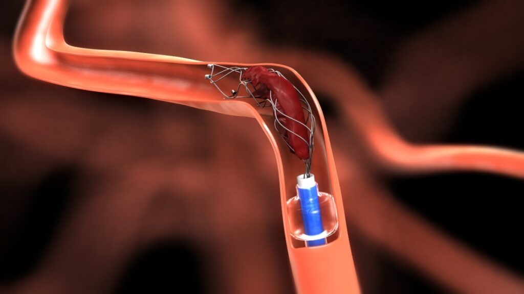 Blood Clot Retrieval Devices Market