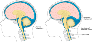 Chiari Malformation Treatment Market Demand Analysis: 2033