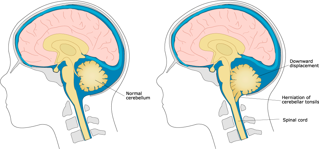 Chiari Malformation Treatment Market