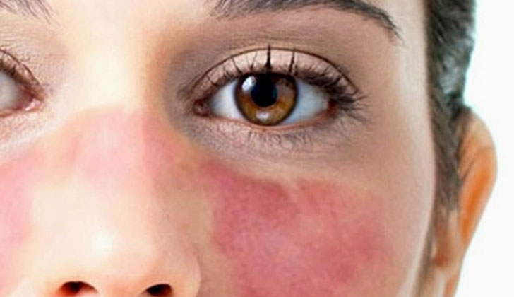 Facial Erythema Treatment Market