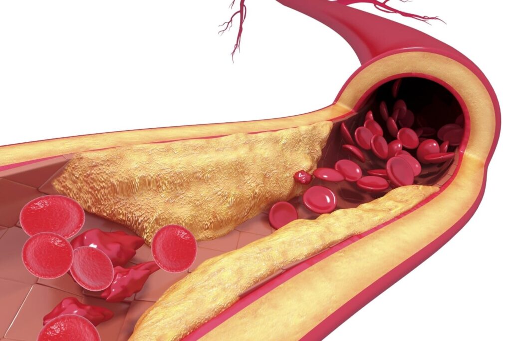 Global Atherosclerosis Industry