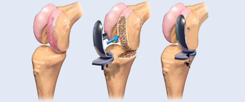 Global Joint Reconstruction Devices Industry
