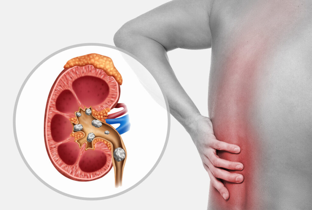 Global Kidney Stone Extraction Market 