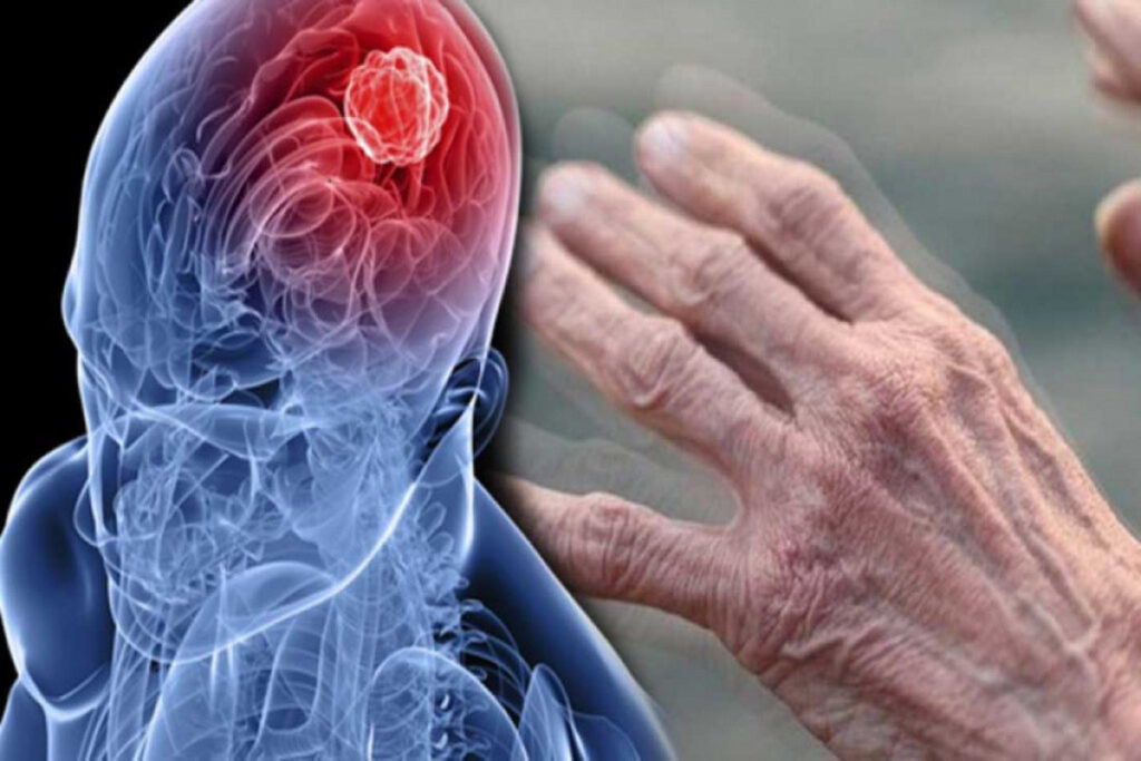 Global Parkinson’s Disease Therapeutics Market