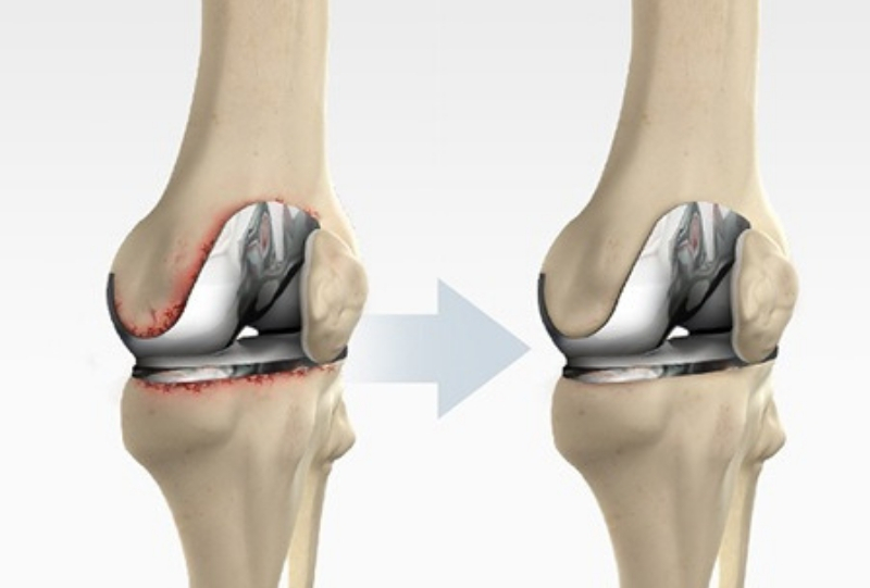 Global  Knee Replacement Market