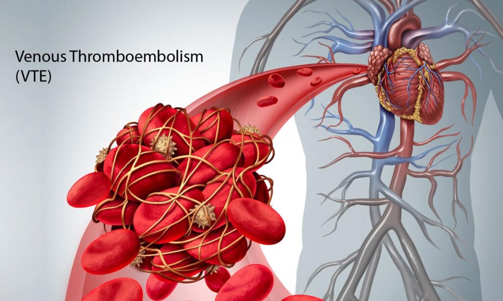 Venous Thromboembolism Treatment Market