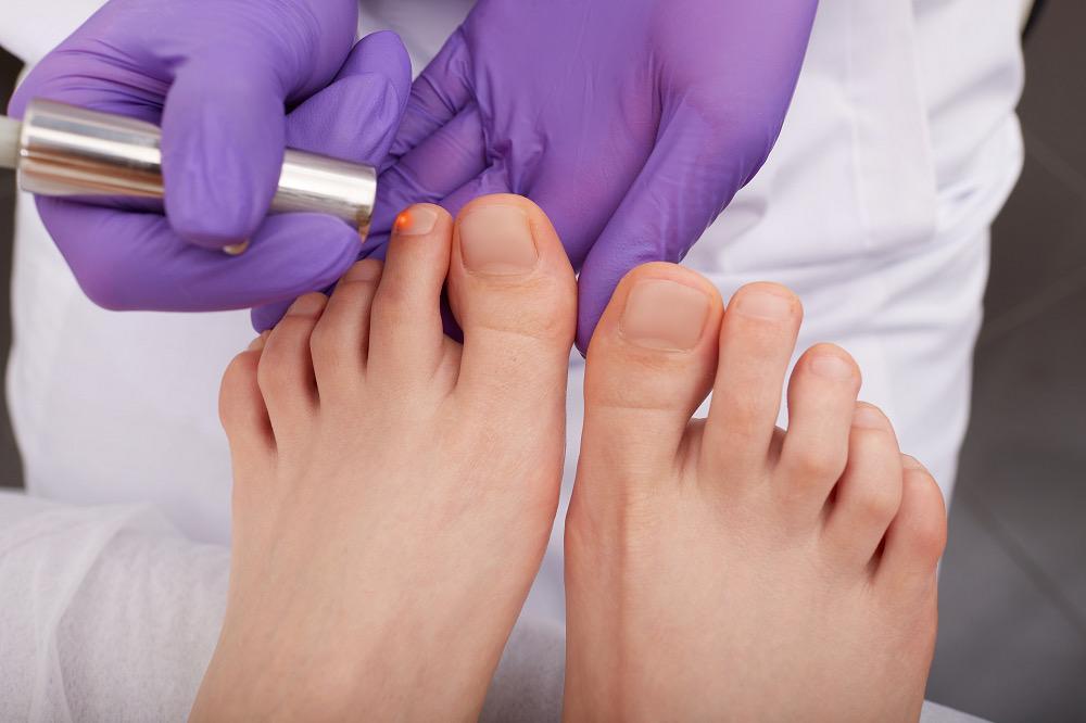 Onychomycosis Treatment Market