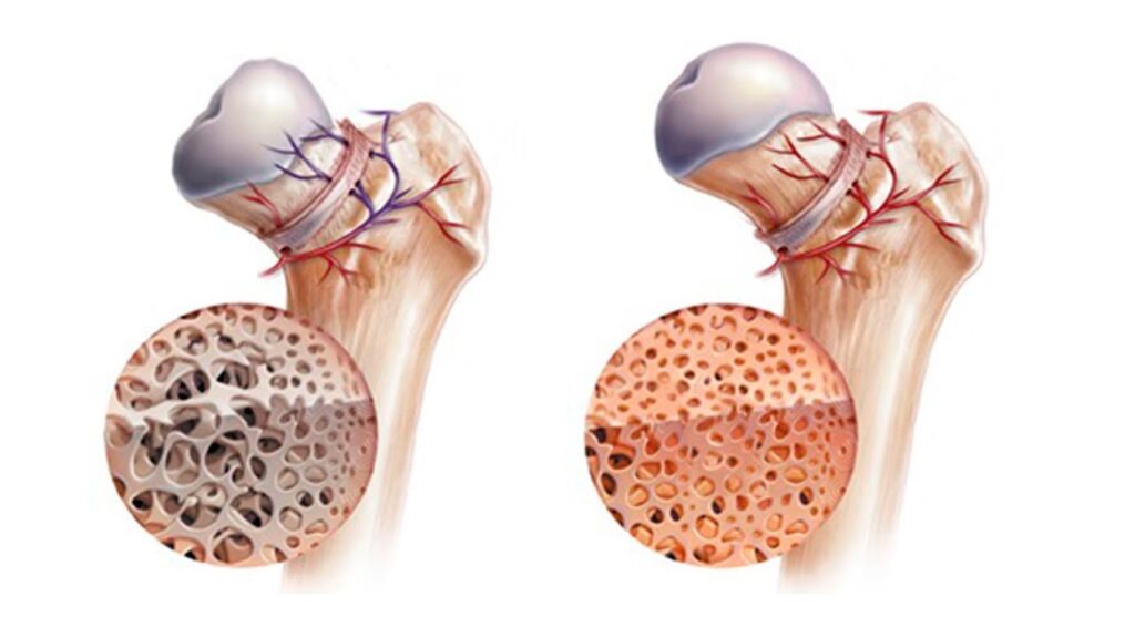 Osteonecrosis Treatment Market