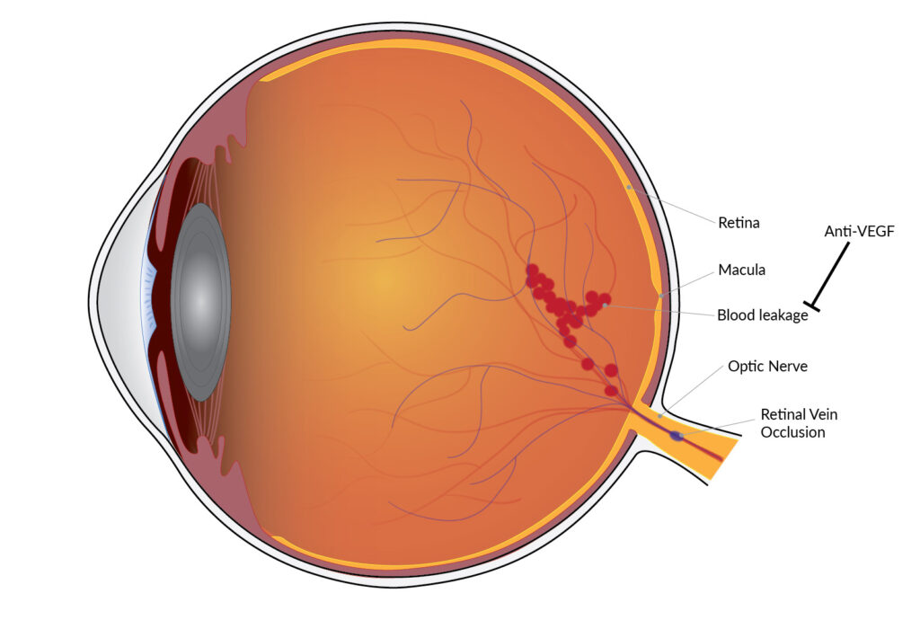 Retinal Vein Occlusion Treatment Market