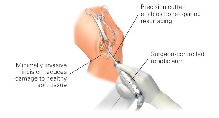 Soft Tissue Repair Market