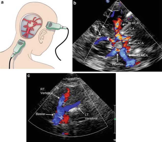 Transcranial Doppler Ultrasound Market