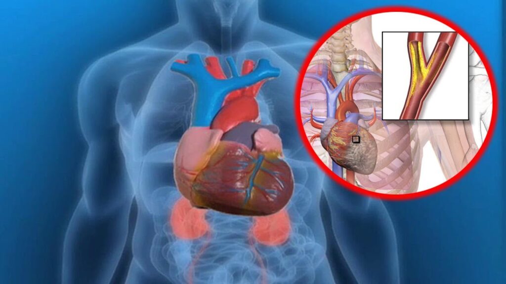 Unstable Angina Therapeutics Market