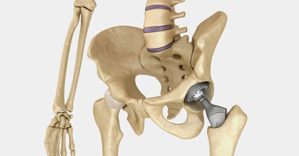 3D Printed Hip and Knee Implants