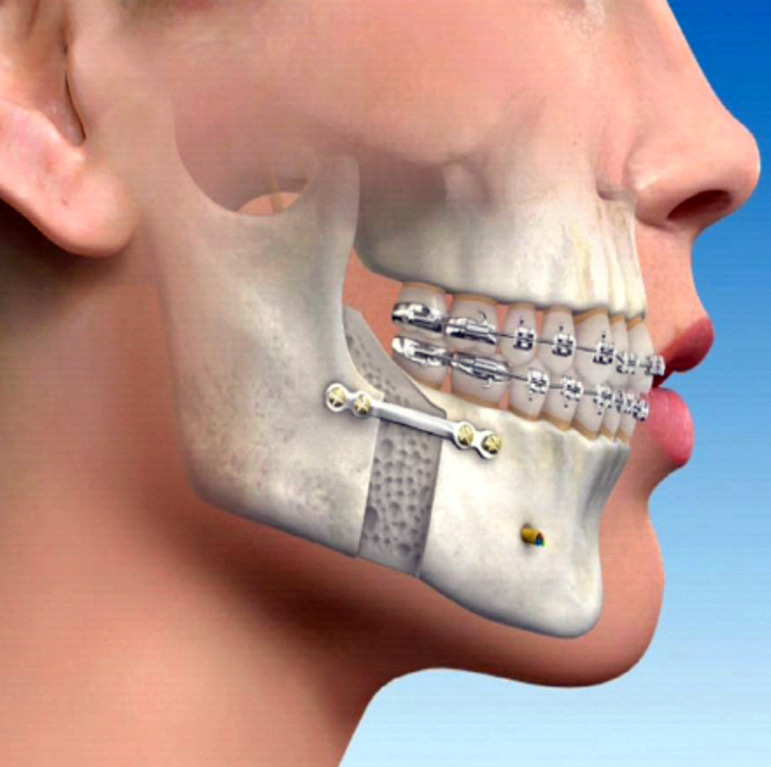 3D Printed Maxillofacial Implants