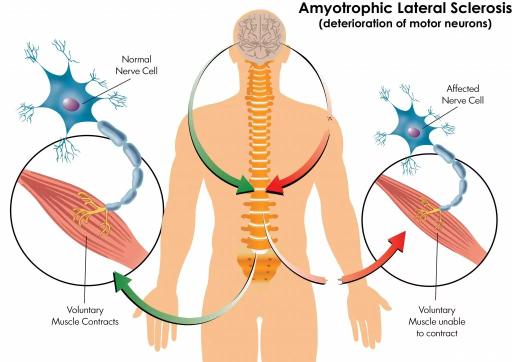 Amyotrophic Lateral Sclerosis Market