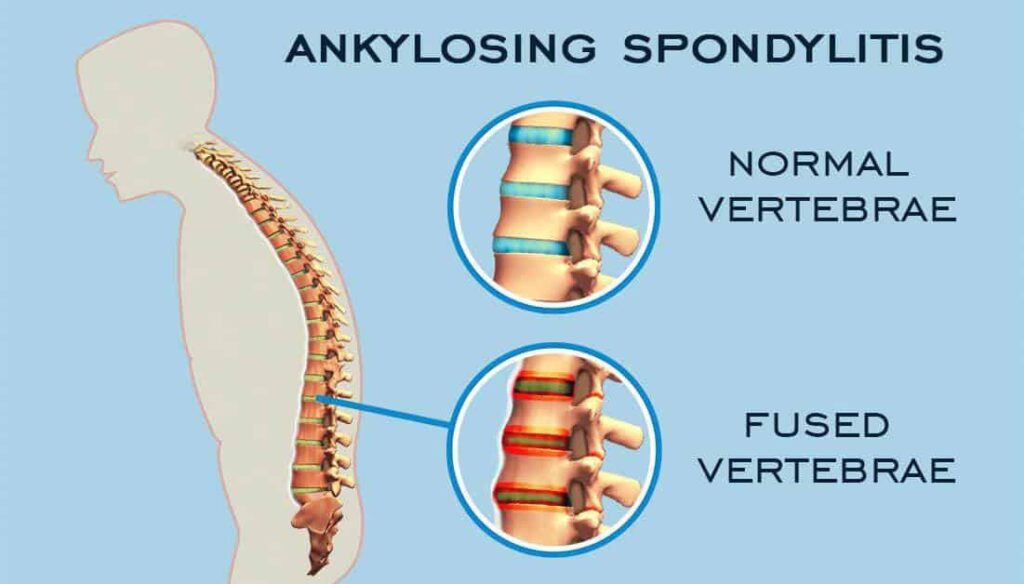 Ankylosing Spondylitis Treatment Market