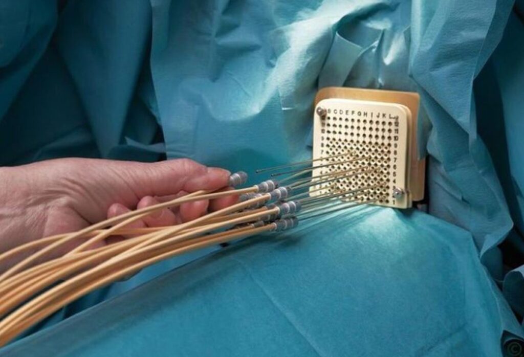 Brachytherapy Market