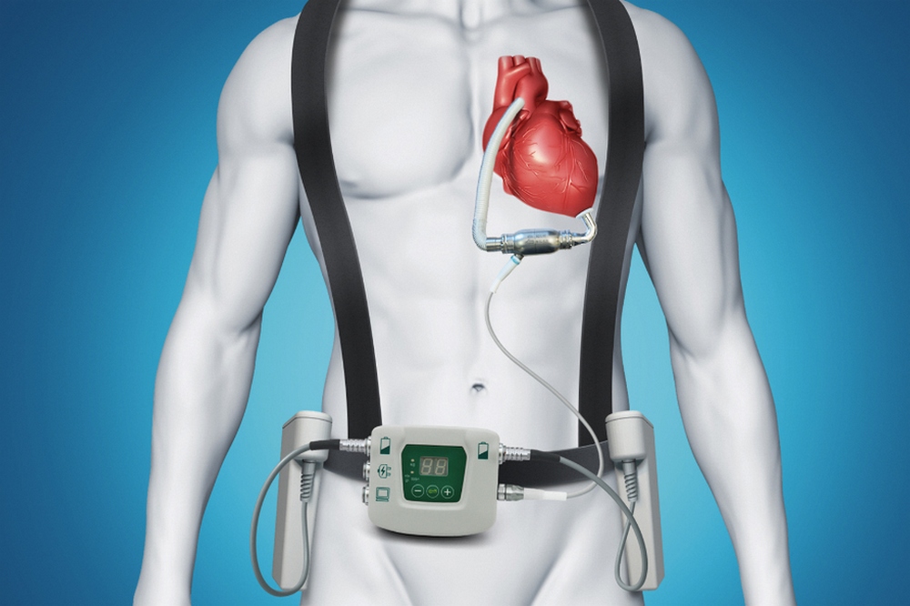 Cardiac Assist Devices