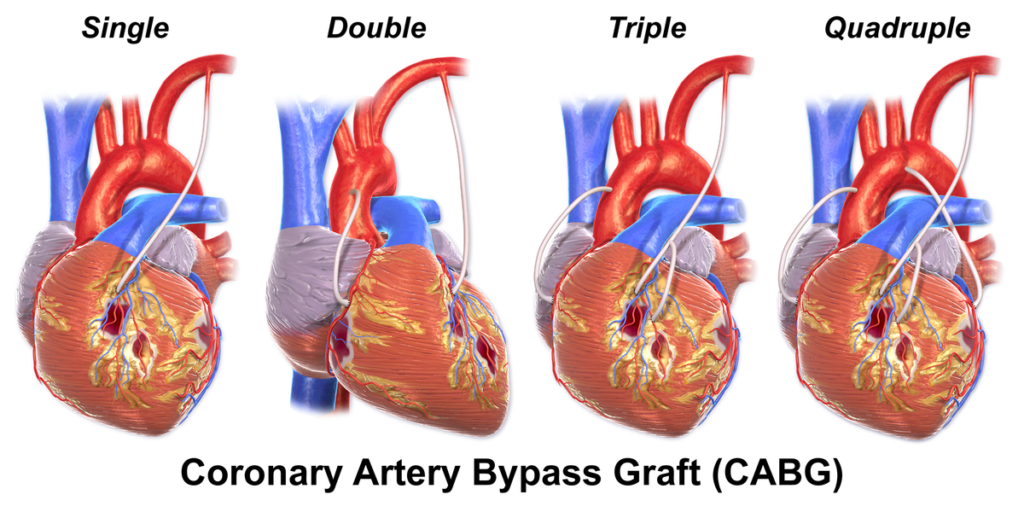 Coronary Artery Bypass Graft Market