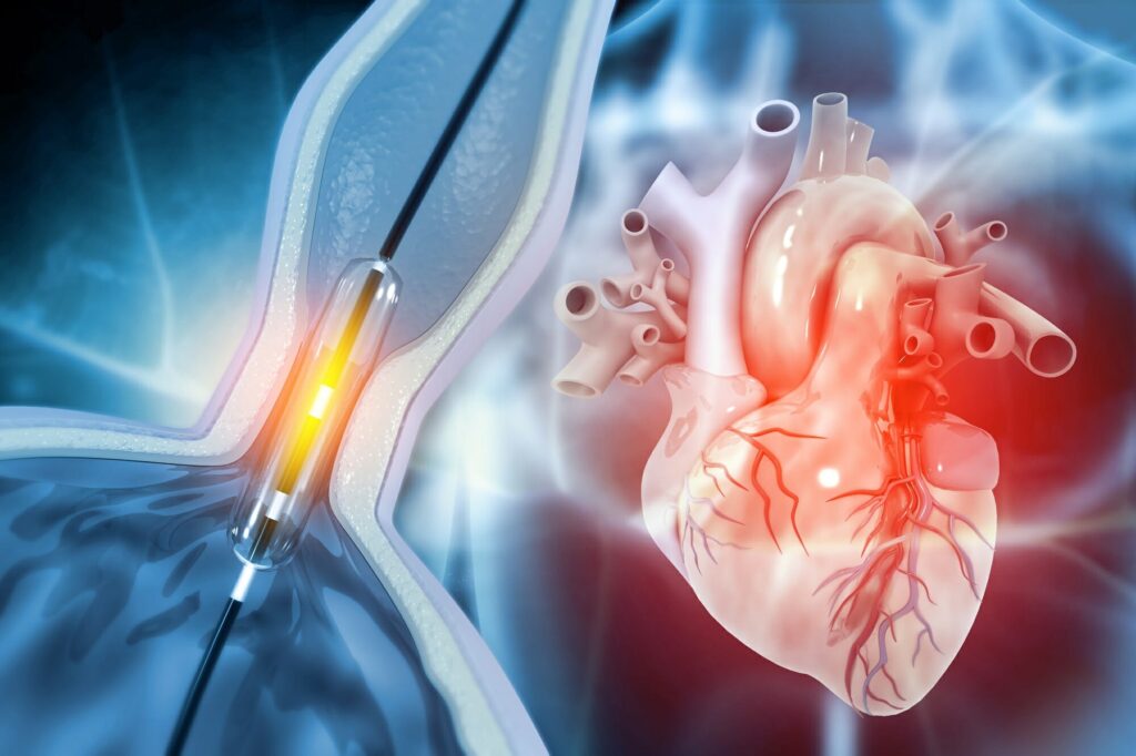 Cryoballoon Ablation System Market