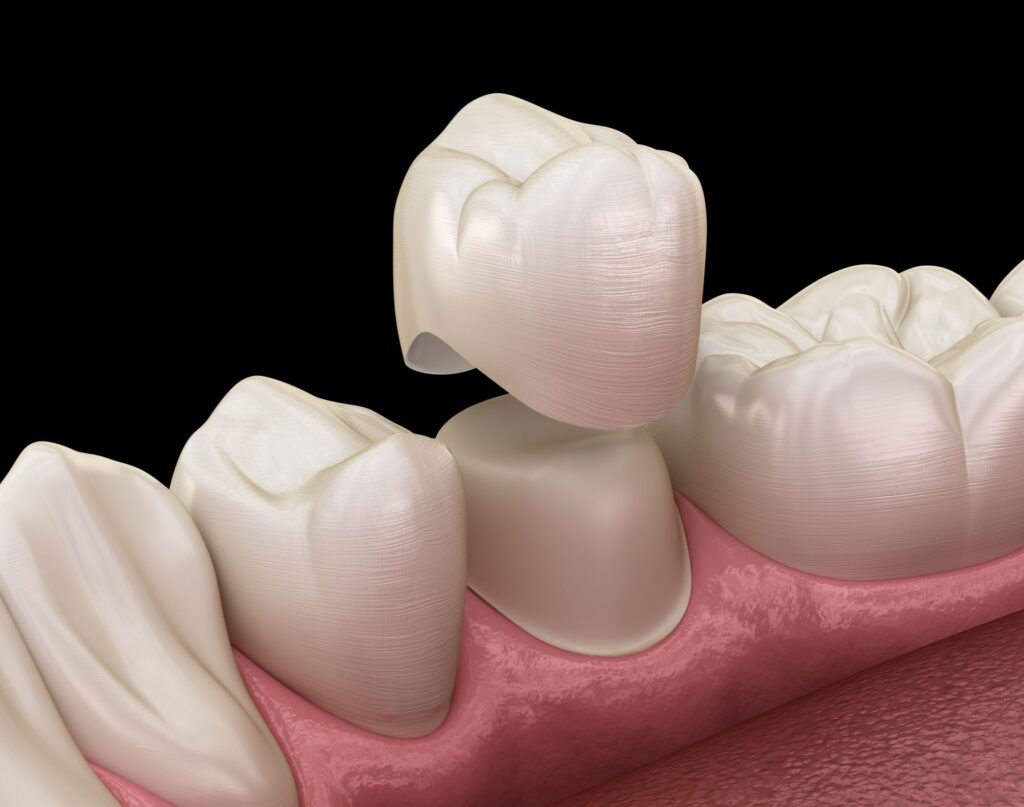 Dental Ceramic Market