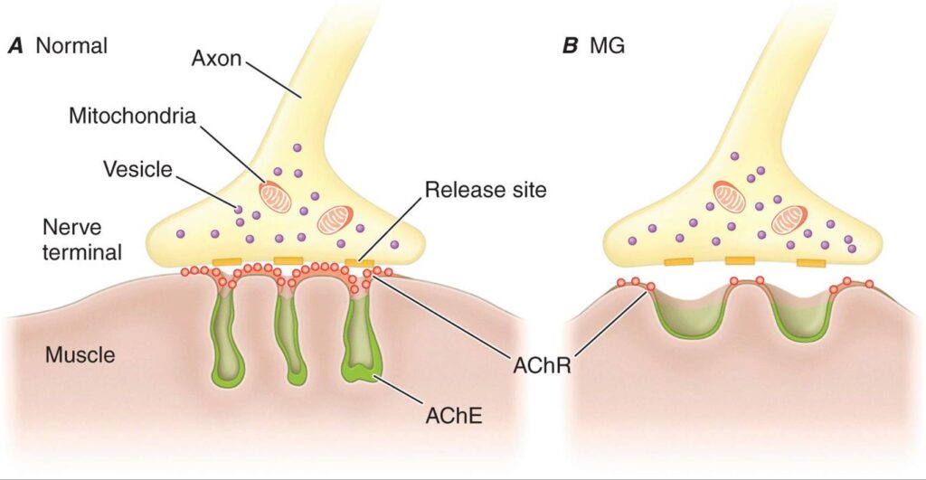 Generalized Myasthenia Gravis (GMG) Management Market