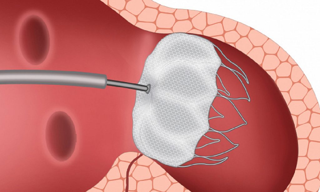 Atrial Appendage Occluder Market