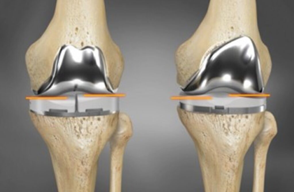 Global Hip and Knee Reconstructive Industry