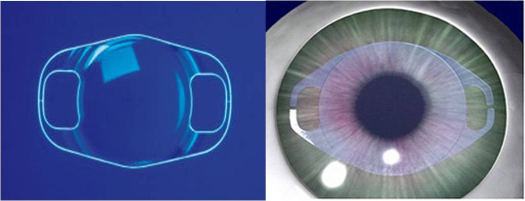 Global Implantable Collamer Lens Industry
